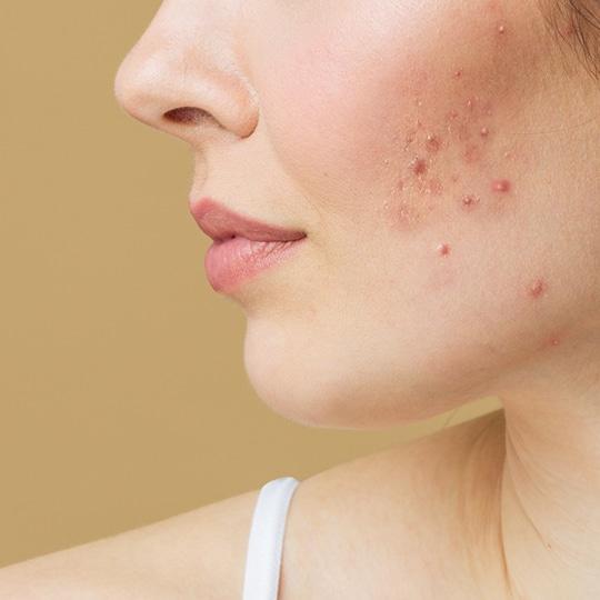 Noreva_Peau_Acne_Peauepaisse_540x540