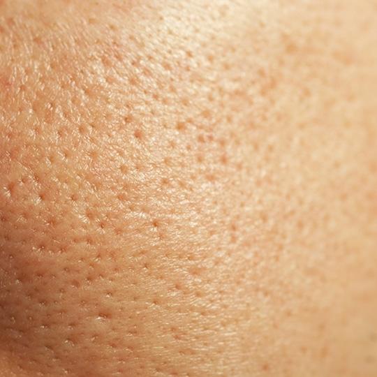 Noreva_Peau_Acne_Poresdilates_540x540