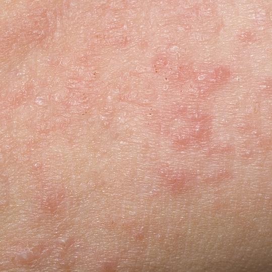 Noreva_Peau_Eczeane-peau rouge qui gratte_Signe3_540x540