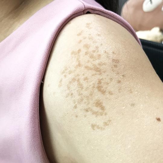 Noreva_Peau_Hyperpigmentees_Corps_540x540