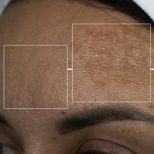 Noreva_Peau_Hyperpigmentees_Visage_540x540
