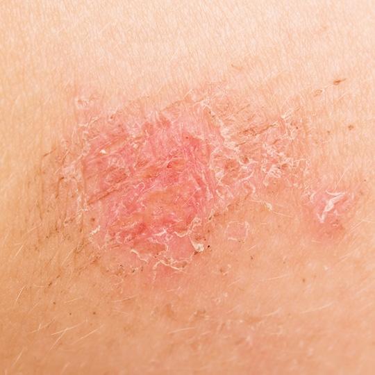 Noreva_Peau_LeseesIrritees-Dartre_Signe2_540x540