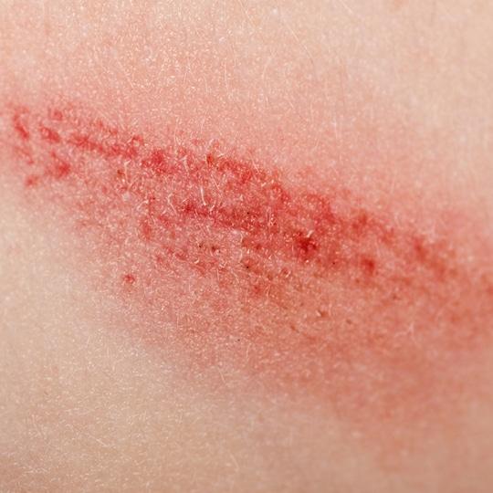 Noreva_Peau_LeseesIrritees-Ecorchures_Signe1_540x540