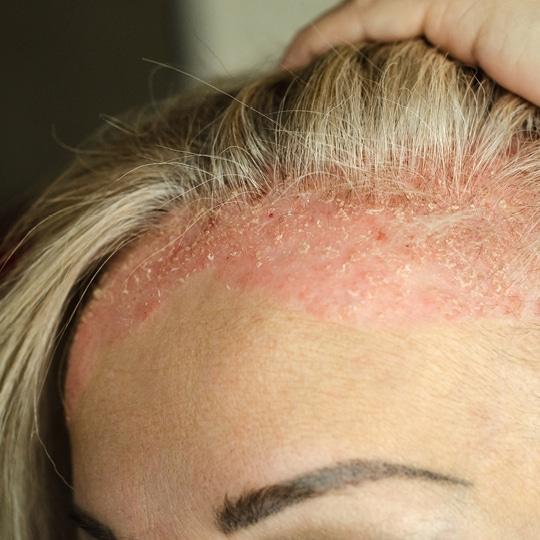 Noreva_Peau_Psoriasis_SquamesCheveux_540x540