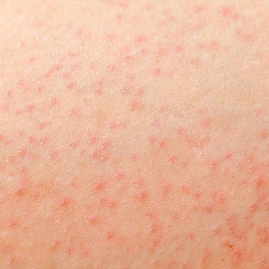 Noreva_Peau_RecheRugueuse_BoutonsPoilsincarnes_540x540