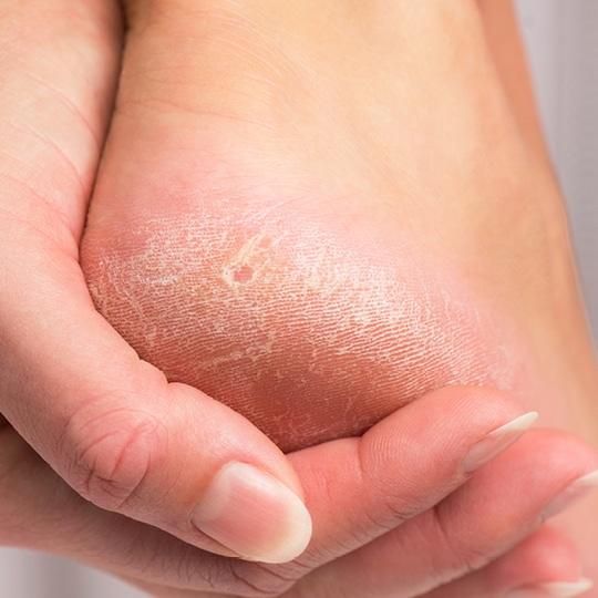 Noreva_Peau_RecheRugueuse_Piedssecs_540x540