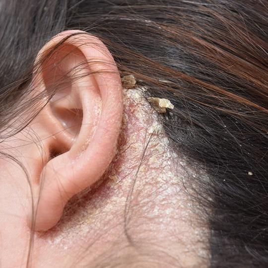 Noreva_Peau_RougeurSquame_Lesionssquameuses_540x540