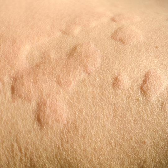 Noreva_Peau_RougeurSquame_PiquresAllergies_540x540