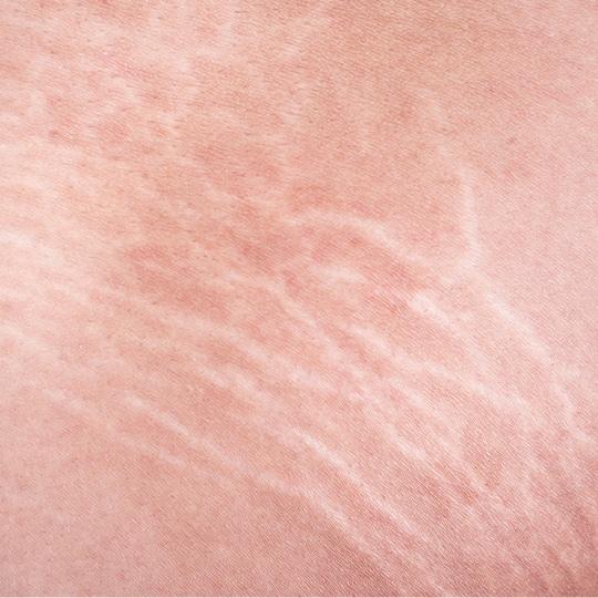 Noreva_Peau_Vergetures_Vergetures_540x540