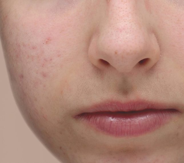 ACNE-apres@3x