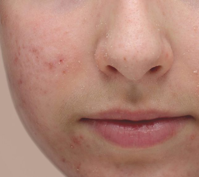 ACNE-avant@3x