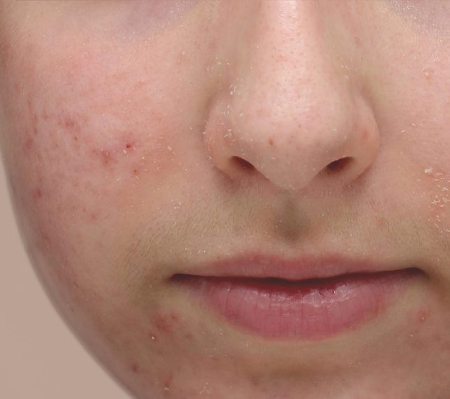 ACNE-avant_644_571